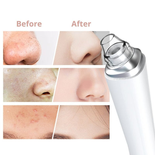 Folliqa™ Facial Pore Cleanser PRO