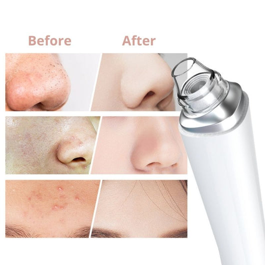 Folliqa™ Facial Pore Cleanser PRO