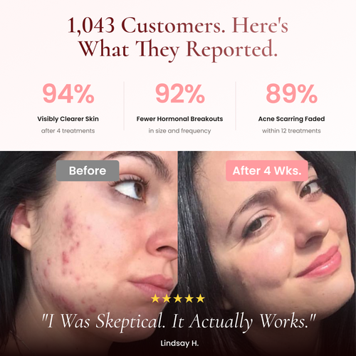 BeautyPro 2.0 - High Frequency Wand
