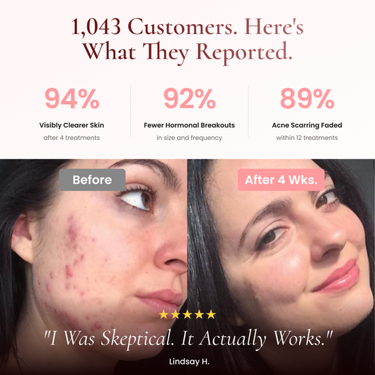 BeautyPro 2.0 - High Frequency Wand
