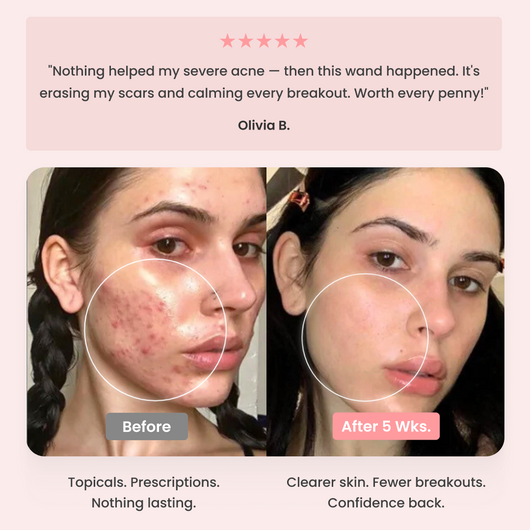 BeautyPro 2.0 - High Frequency Wand
